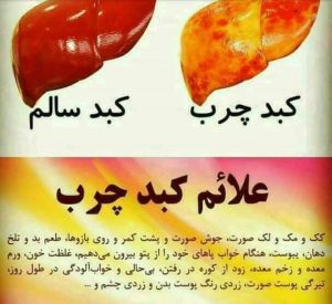 علائم کبد چرب