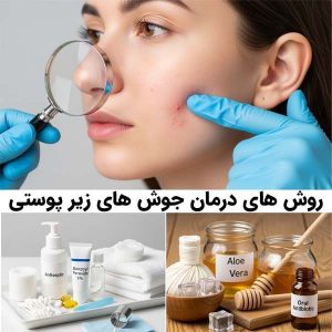 درمان جوش های زیر پوستی